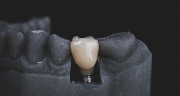 Prótesis dental en Andújar