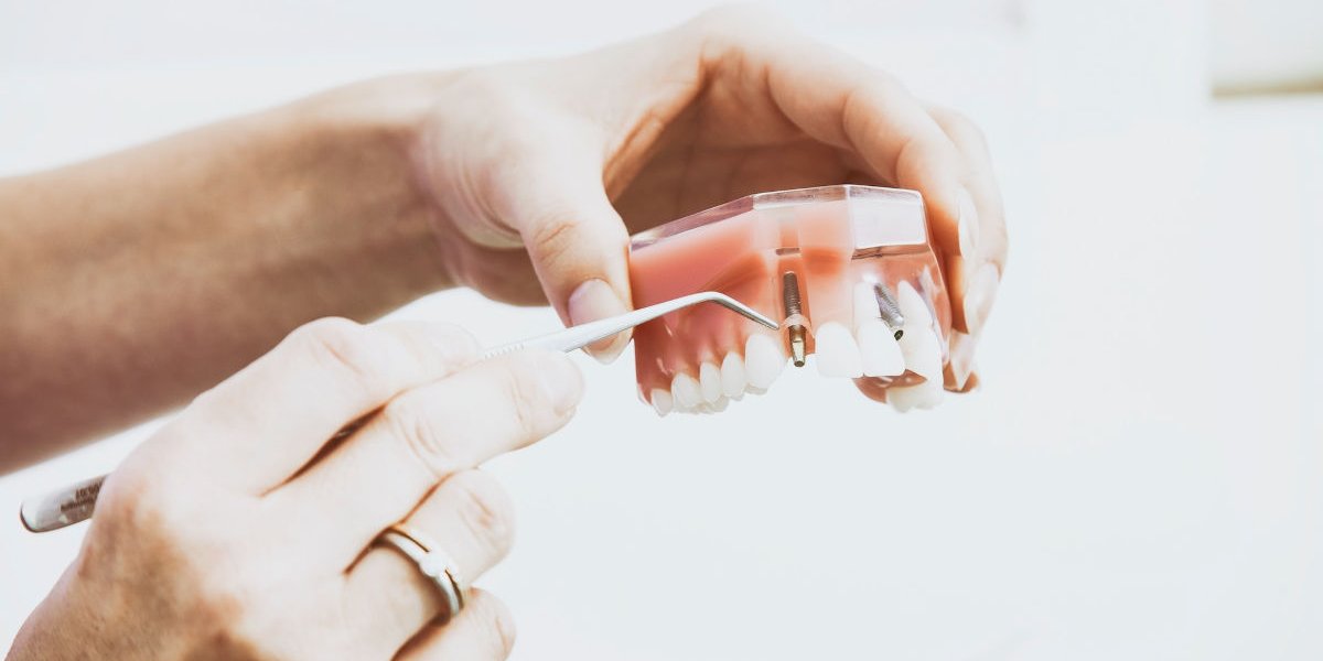 Implantes dentales en Andújar